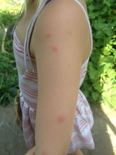 Itch relief for mosquito bites is mandatory in case of allergy