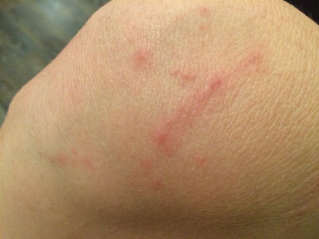 Allergic reaction to bed bug bites