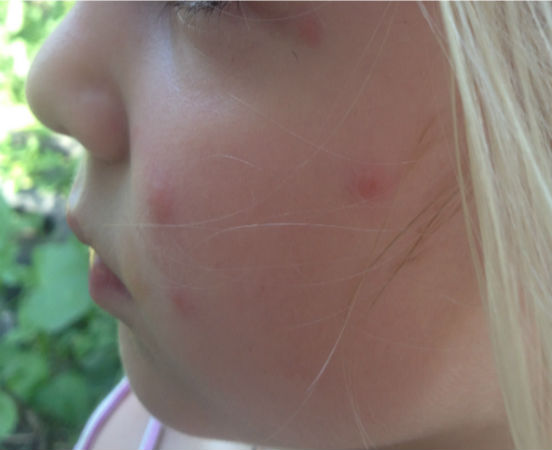 Mosquito Bites On Kids First Aid Treatment