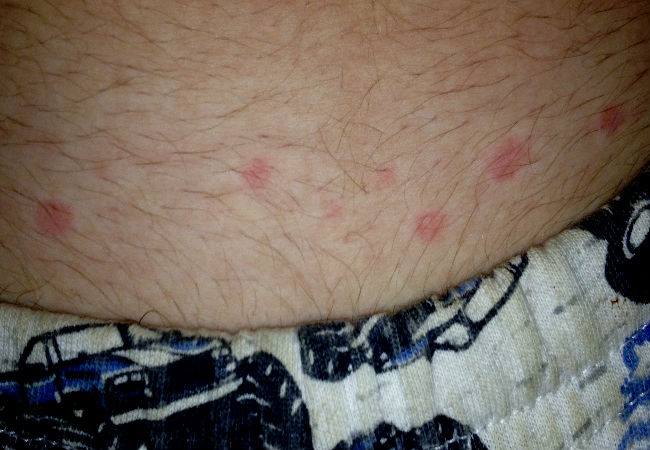 Bed bug bites photo