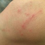 How to treat allergic reactions to the bedbug bites on the skin