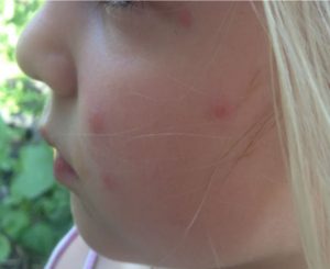 Mosquito bites on kids picture