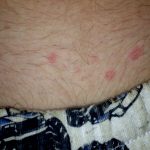 How to get rid of bed bug bites at home