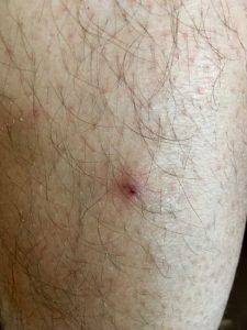 Tick can cuase viral tick disease through its bite